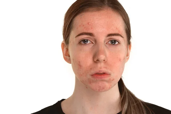 Bella ragazza con pelle problematica, concetto di problema di acne — Foto Stock