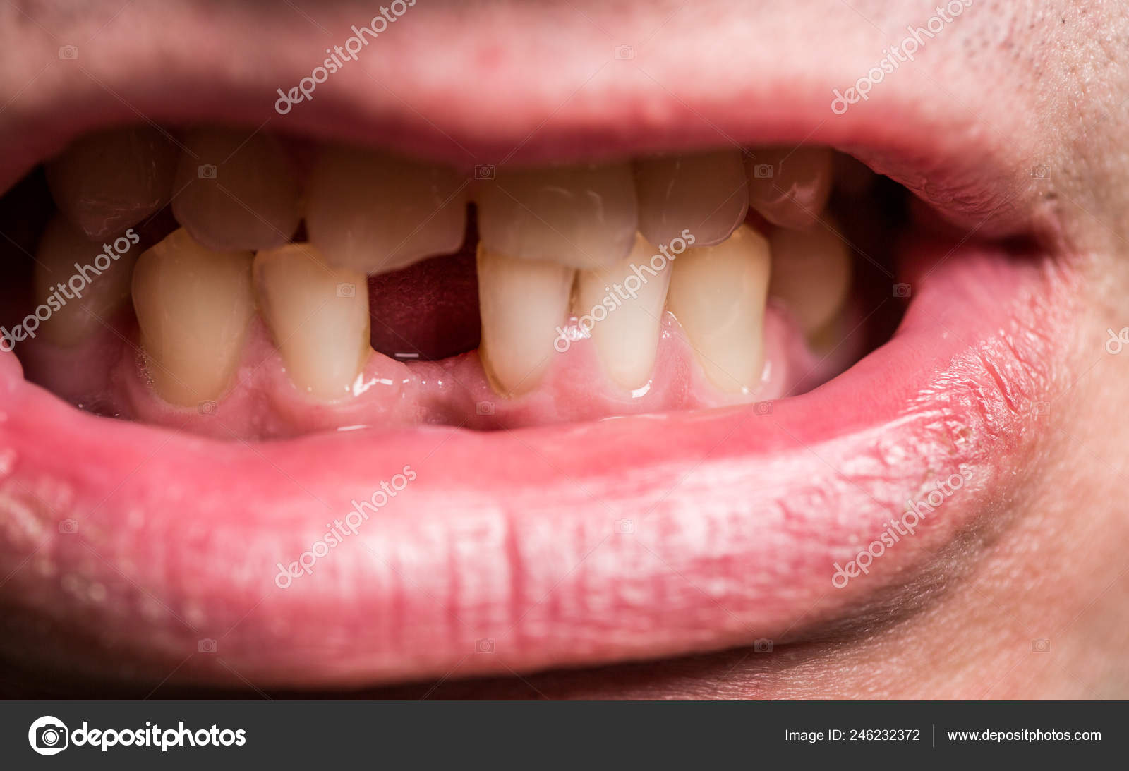 Un homme sans une dent avant. Mauvaise santé dentaire, pas de dents, pas de  fluorure, érosion, image size:1600x1093