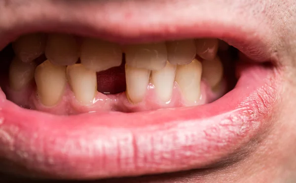 Un hombre sin un diente delantero. Mala salud dental, sin dientes, sin flúor, erosión dental. Sin dientes. Hombres sonrientes con un diente delantero perdido, dolor de muelas. Dientes amarillos — Foto de Stock