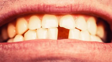 Sarı dişli. Sarı kötü dişler. Ön dişi olmayan bir adam. Dişleri yok. Ön dişleri dökülmüş gülümseyen adamlar, diş ağrıları. Diş sağlığı kötü, diş yok, florür yok, diş aşınması var.