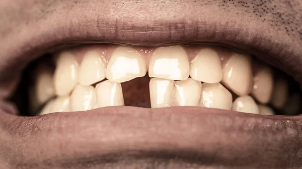 Mala salud dental, sin dientes, sin flúor, erosión dental. Sin dientes. Hombres sonrientes con un diente delantero perdido, dolor de muelas. Dientes amarillos. Hombre sin un diente delantero —  Fotos de Stock