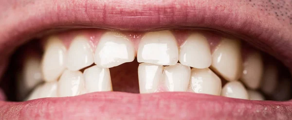 Denti gialli cattivi. Sorridi agli uomini con un dente anteriore perso, mal di denti. Un uomo senza un dente anteriore. Niente denti. Denti gialli. Cattiva salute dentale, nessun dente, nessun fluoro, erosione dentale — Foto Stock