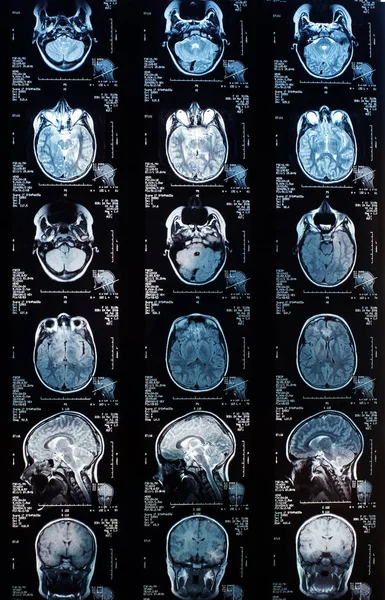 magnetic resonance image (MRI) of the brain.