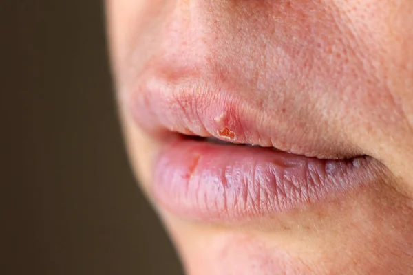 Herpes Lip Close Macro — Stock Photo, Image