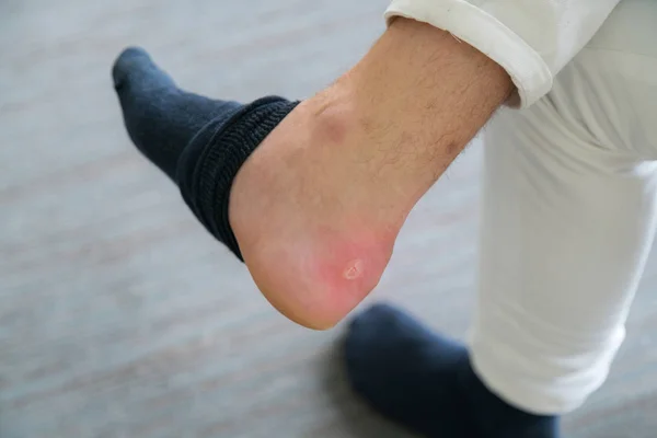 Painful Heel wound on mans feet caused by new shoes. Cracked terrible blister on human heel with new brown fashion shoes laying around. Wet bloody painful skin on man foot with plaster