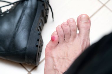 Kanlı korkunç blister etrafında döşeme yeni siyah deri ayakkabı ile insan ayakları üzerinde. Adam ayak sıva ile kanlı acı cilt ıslak. Acı yaraya neden tarafından yeni ayakkabılar ayak mans.