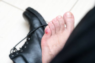 Kanlı korkunç blister etrafında döşeme yeni siyah deri ayakkabı ile insan ayakları üzerinde. Adam ayak sıva ile kanlı acı cilt ıslak. Acı yaraya neden tarafından yeni ayakkabılar ayak mans.