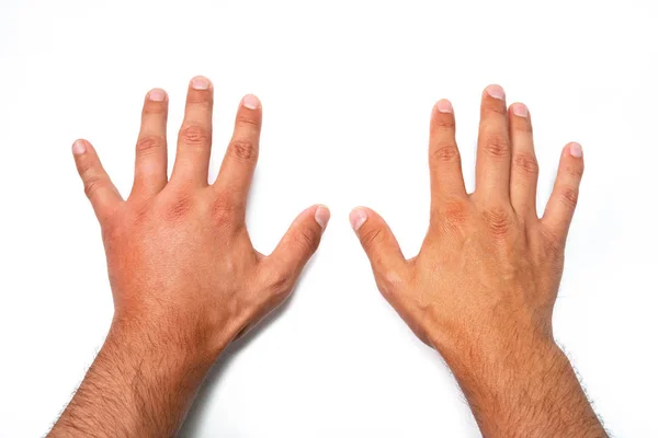Сравнение двух мужских рук, укушенных пчелой или осой. Опухание рук, воспаление, покраснение являются признаками инфекции. Укус насекомого на белом фоне — стоковое фото
