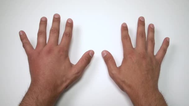 Comparison Two Male Hands Stung Bee Wasp Hand Swelling Inflammation — Stock Video