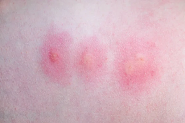 Sivrisinek Için Ayak Isır Nflamasyon — Stok fotoğraf