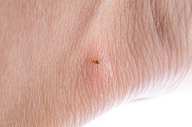 İnsan derisiüzerinde kene Makro fotoğraf emme