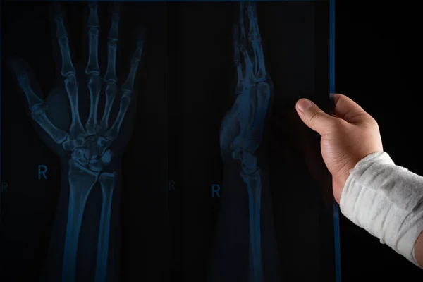Студійний Знімок Чоловіка Який Дивиться Рентгенівський Фільм Загорнутою Рукою Медичної — стокове фото