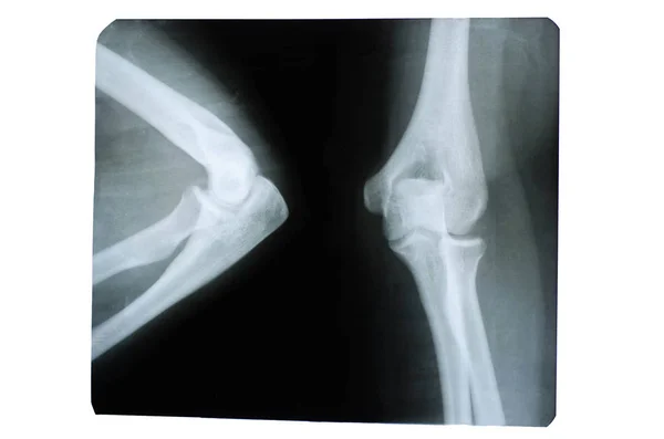 Photo of a human x-ray of a joint in the elbow area. — Stock Photo, Image