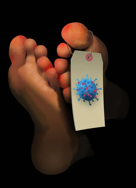 코로나 바이러스 환자의 발가락에 발진이 생기는 토스를 예에서 수있다 — 스톡 사진