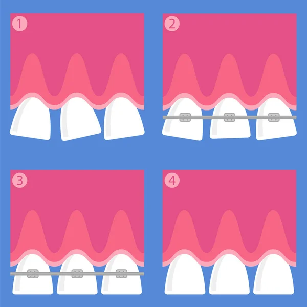 Aparelhos dentários. Antecedentes de cuidados dentários. Tratamento Ortodôntico. Boca de abertura dos desenhos animados . — Vetor de Stock