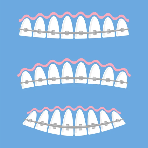 Medische accolades tanden. Tandheelkundige zorg achtergrond. Orthodontische behandeling. Cartoon opening mond — Stockvector