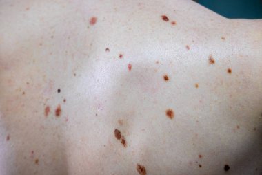 Melanositik nevus, bazıları dyplastik veya atipik, 36 yaşında bir kafkas adam üzerinde