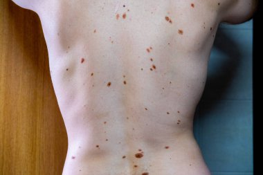Melanositik nevus, bazıları dyplastik veya atipik, 36 yaşında bir kafkas adam üzerinde