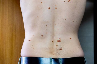 Melanositik nevus, bazıları dyplastik veya atipik, 36 yaşında bir kafkas adam üzerinde
