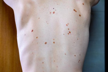 Melanositik nevus, bazıları dyplastik veya atipik, 36 yaşında bir kafkas adam üzerinde