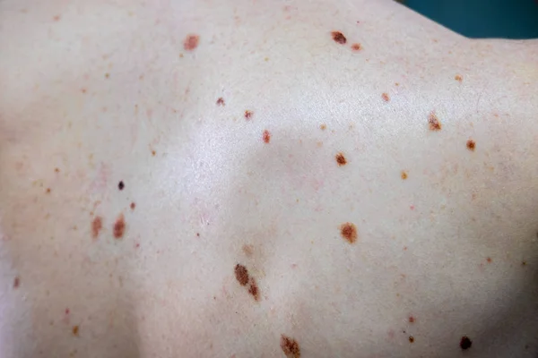 Melanositik nevus, bazıları dyplastik veya atipik, 36 yaşında bir kafkas adam üzerinde
