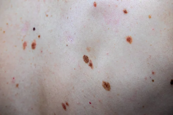 Nevo melanocitico, alcuni dei quali diplastici o atipici, su un uomo caucasico di 36 anni — Foto Stock