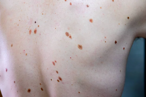 Melanocytic nevus, some of them dyplastic or atypical, on a caucasian man of 36 years old — Stock Photo, Image