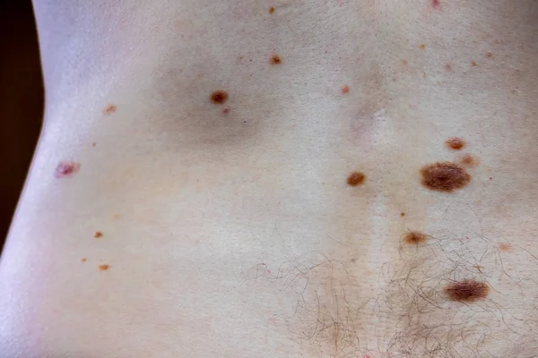 Nevo melanocitico, alcuni dei quali diplastici o atipici, su un uomo caucasico di 36 anni — Foto Stock