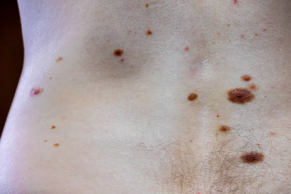 Melanocita nevus, némelyik dyplastic vagy atipikus, egy kaukázusi ember 36 éves — Stock Fotó