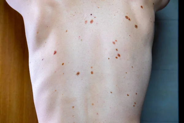 Melanocytic nevus, some of them dyplastic or atypical, on a caucasian man of 36 years old — Stock Photo, Image