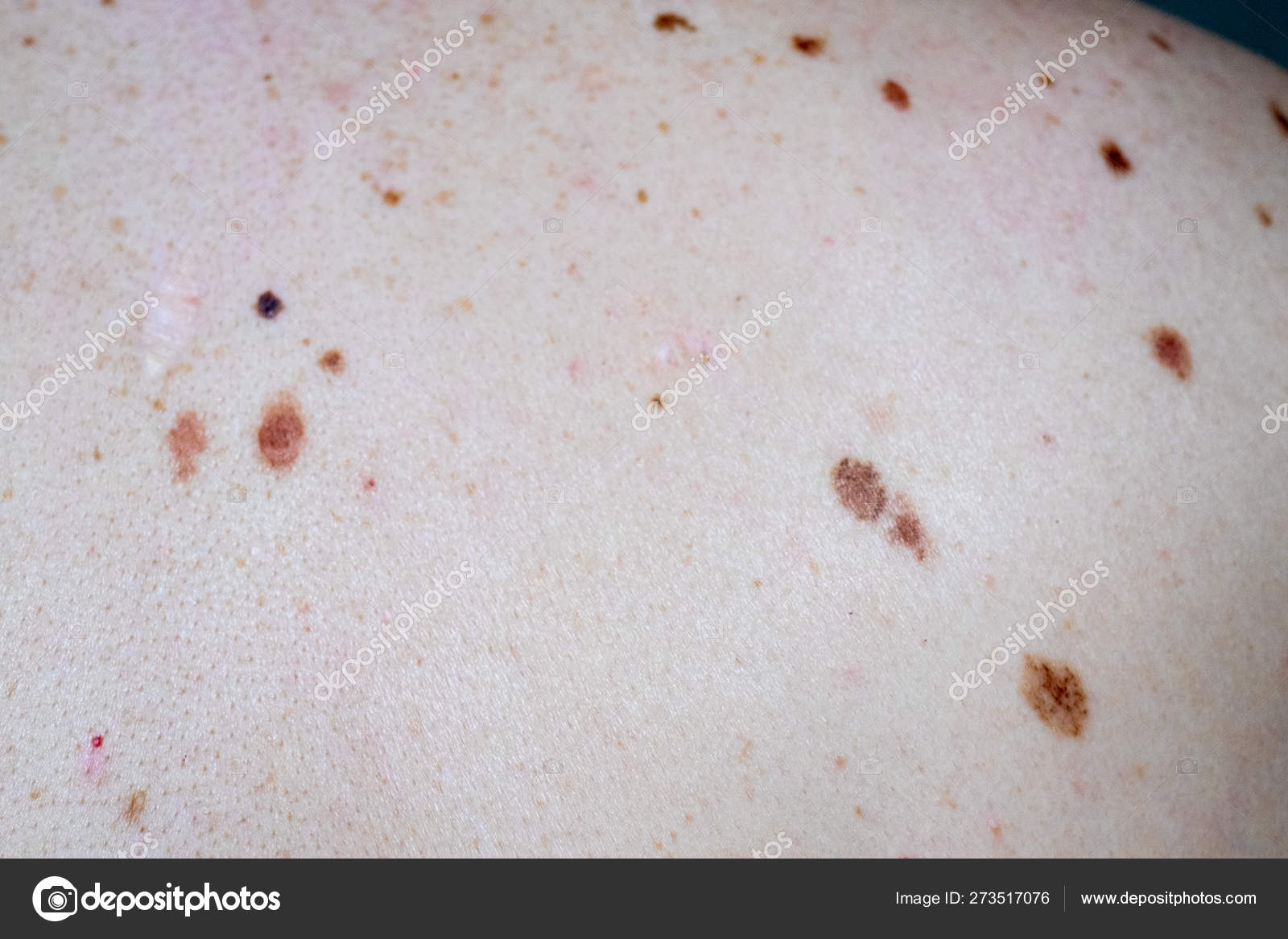 Nevus melanocítico, algunos de ellos displásicos o atípicos, en un hombre  caucásico de 36 años — Foto de stock #273517076 © mikelju, image size:1600x1167