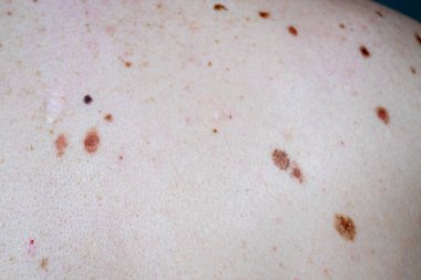 Melanositik nevus, bazıları dyplastik veya atipik, 36 yaşında bir kafkas adam üzerinde