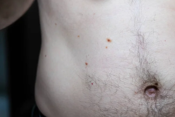 Melanocita nevus, némelyik dyplastic vagy atipikus, egy kaukázusi ember 36 éves — Stock Fotó