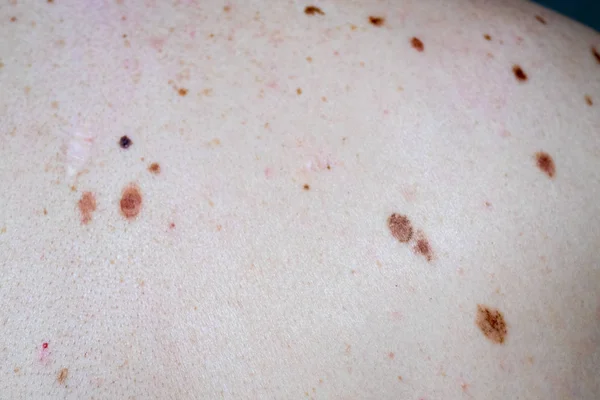 Melanocytic nevus, some of them dyplastic or atypical, on a caucasian man of 36 years old — Stock Photo, Image