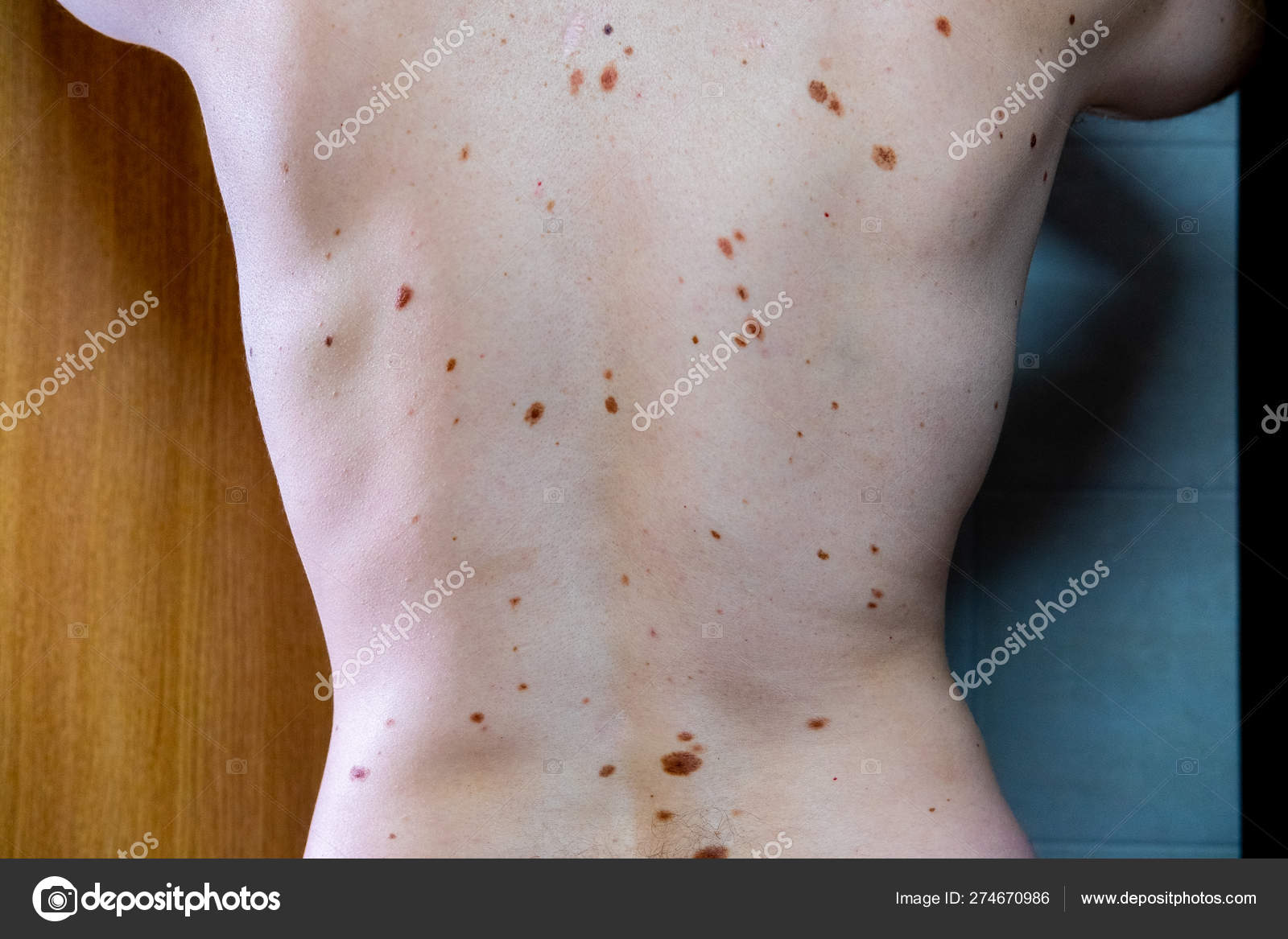 Nevus melanocítico, algunos de ellos displásicos o atípicos, en un hombre  caucásico de 36 años — Foto de stock #274670986 © mikelju, image size:1600x1167