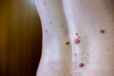 Melanositik nevus, bazıları dyplastik veya atipik, 36 yaşında bir kafkas adam üzerinde