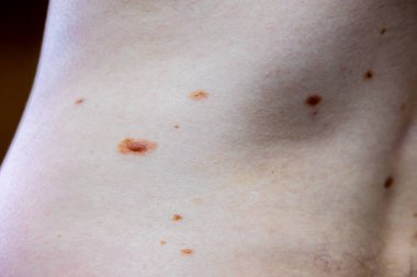Melanositik nevus, bazıları dyplastik veya atipik, 36 yaşında bir kafkas adam üzerinde