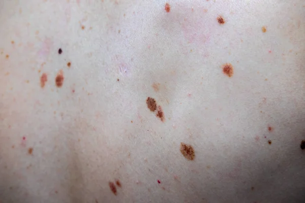 Melanositik nevus, bazıları dyplastik veya atipik, 36 yaşında bir kafkas adam üzerinde