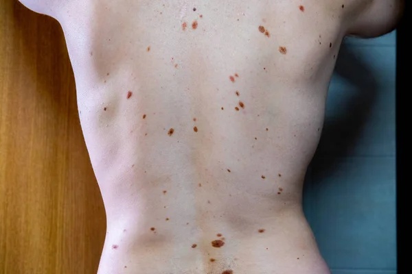 Melanositik nevus, bazıları dyplastik veya atipik, 36 yaşında bir kafkas adam üzerinde