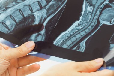 Kadın doktorların elleri röntgene ya da boyun ve kafa rahatsızlığı olan MRI görüntülerine bakıyor. Omurilik, kan damarları. Nörolojik tıp. Sağlık ve ilaç servisi. Sakatlık. Kemik dokuları.