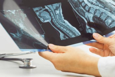 Kadın doktorların elleri röntgene ya da boyun ve kafa rahatsızlığı olan MRI görüntülerine bakıyor. Omurilik, kan damarları. Nörolojik tıp. Sağlık ve ilaç servisi. Sakatlık. Kemik dokuları.