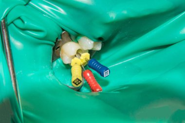 Fotoğraf endodontik tedavi alt azı kalıcı diş Endodontik dosyasıyla molar diş kanallar ile apex arama, diş cofferdam tarafından bağlı kelepçe ile