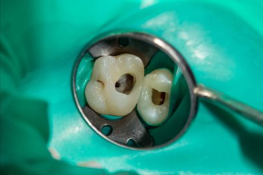 Fotoğraf endodontik tedavi alt azı kalıcı diş Endodontik dosyasıyla molar diş kanallar ile apex arama, diş cofferdam tarafından bağlı kelepçe ile