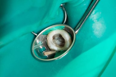 Diş kökleri tedavisinde. Mühürleme ve makro carious insan dişi close-up Temizleme. Yenilik ve teknoloji modern endodontik tedavi hastaların kavramı