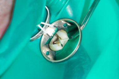 endodontik tedavi diş yakın çekim. Onların dolum ve diş köklerinin temizlik. Diş kliniğinde modern teknoloji kavramı