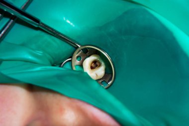 endodontik tedavi diş yakın çekim. Onların dolum ve diş köklerinin temizlik. Diş kliniğinde modern teknoloji kavramı