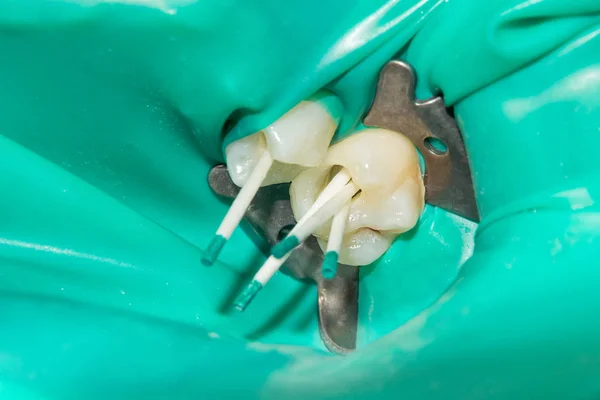 Tratamiento Fotoendodóntico Canales Dentales Molar Inferior Permanente Del Molar Con —  Fotos de Stock