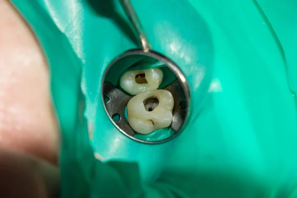 クローズ アップには 歯科用充填腐ったクリニックでヒトの歯が扱われます クリーニングと運河ゴム シール システムとステージングの使用を — ストック写真