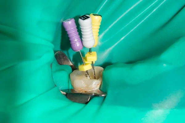 Closeup Treated Human Tooth Dental Filling Rotten Clinic Cleaning Canals — Stock Photo, Image