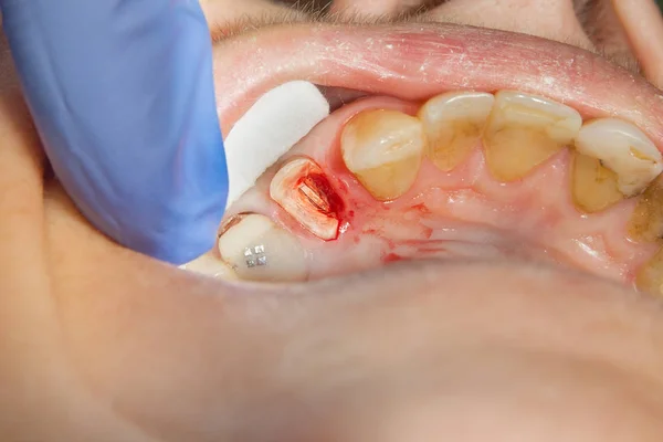 Tratamento Endodôntico Dos Dentes Close Limpeza Das Raízes Dos Dentes — Fotografia de Stock